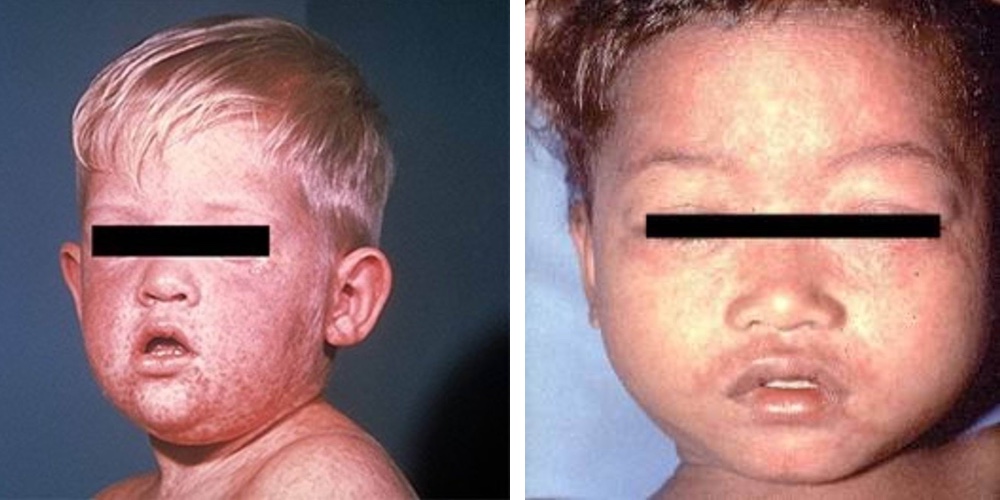 children with measles